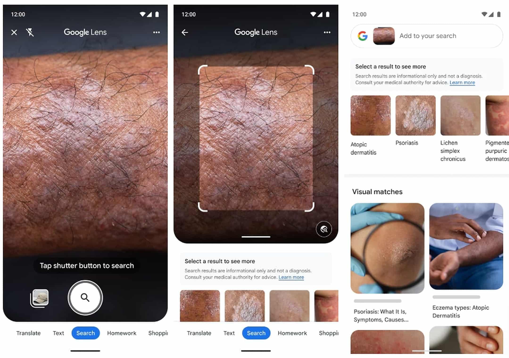 Google Lens condizioni pelle IA