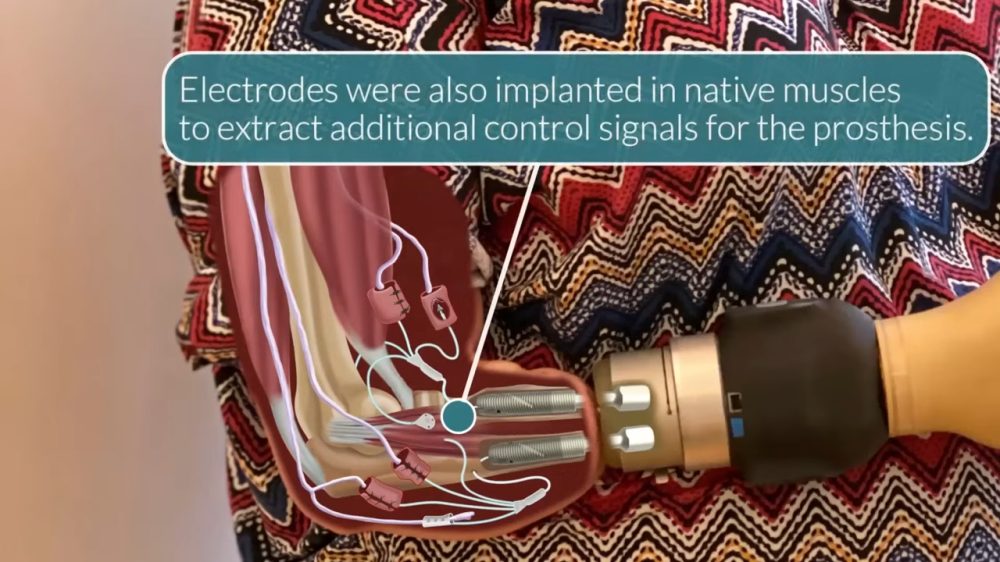 Protesi bionica elettrodi