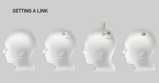 Neuralink: come funziona l'interfaccia che connette macchina e cervello umano